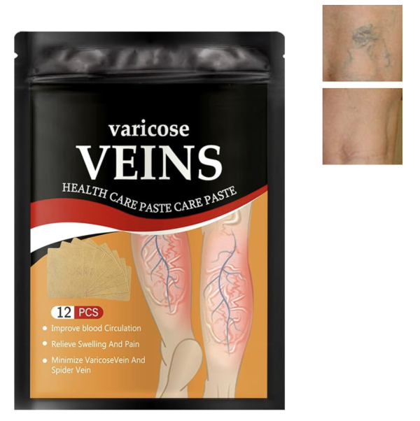 Parche Varices